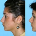 The Best Rhinoplasty Surgeon In Beverly Hills CA