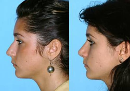 The Best Rhinoplasty Surgeon In Beverly Hills CA